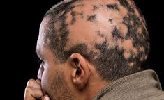 Alopecia Hair Loss Oil Treatment - Image 2
