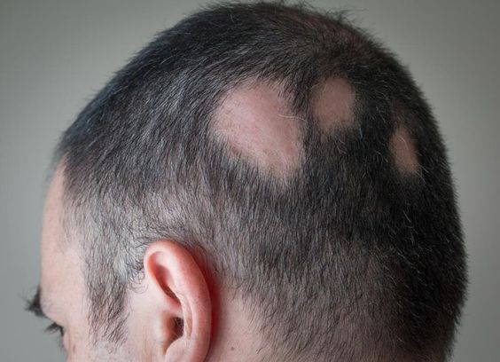 Alopecia Hair Loss Oil Treatment - Image 3